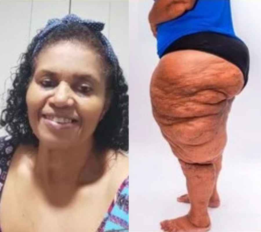 Moradora de Gandu inicia vaquinha para tratamento de lipedema